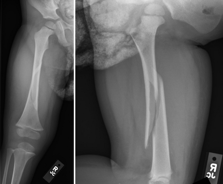 Pictures Of Spiral Fractured Femur 37