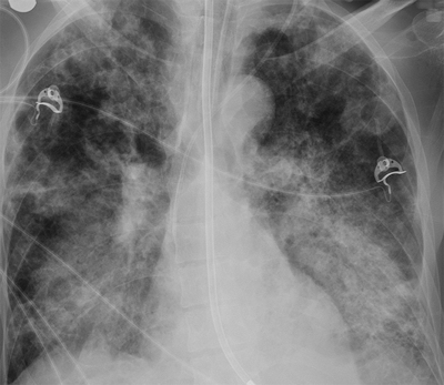 Lung x-rays predict mortality in MERS patients
