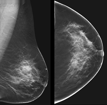 Hologic to Highlight 3-D Mammography at RSNA 2014