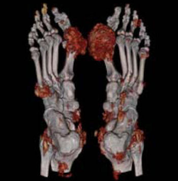 Gout+Foot+Mri But the prospect of fast, sure, noninvasive diagnosis ...