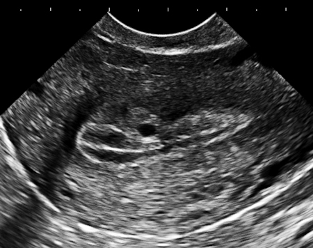 Endovaginal Ultrasound Pictures 18