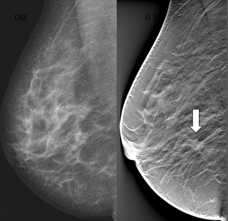 Breast tomosynthesis increases cancer detection and reduces recall rates