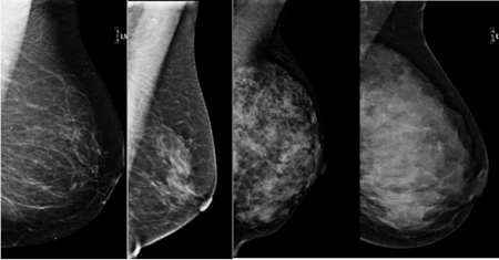 Don't Blame Breast Density; $$$ Toxicity; Nurse Ratched Returns