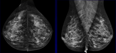  62-year-old woman with nonpalpable 9-mm invasive ductal carcinoma not seen on mammography