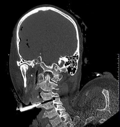 CT image of a knife-attack victim