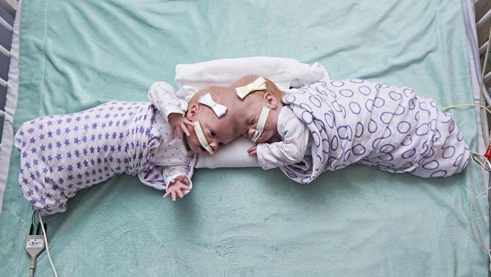 Craniopagus conjoined twins Erin and Abby Delaney