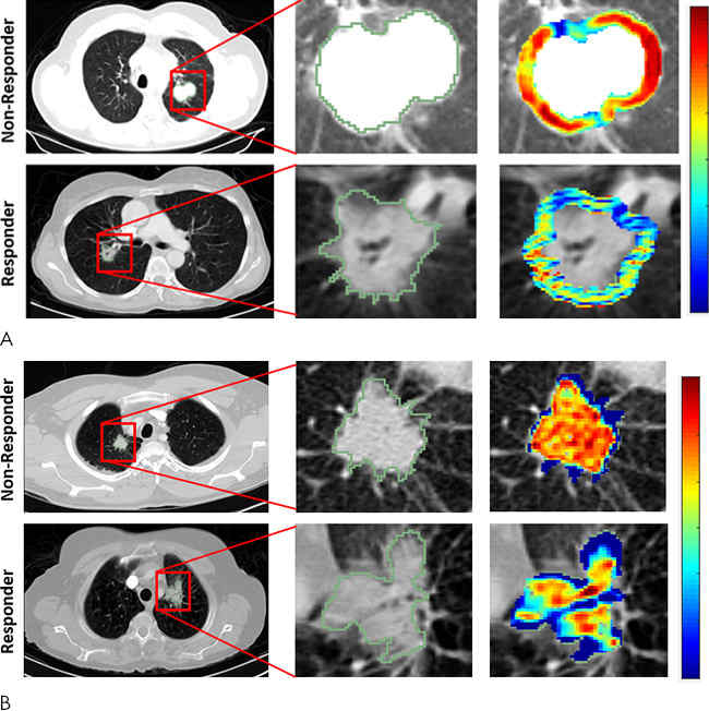 Radiomic feature maps of pretreatment CT