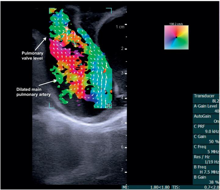Vector flow imaging demonstrates swirl of blood flow within the dilated main pulmonary artery of a pig.