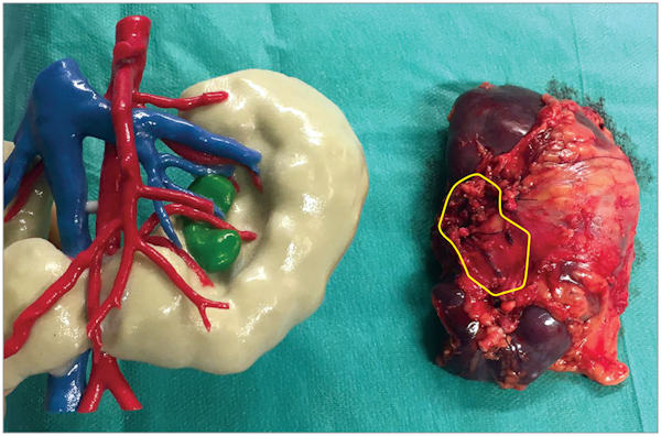 Kidney specimen (right) with corresponding 3D-printed kidney (left)