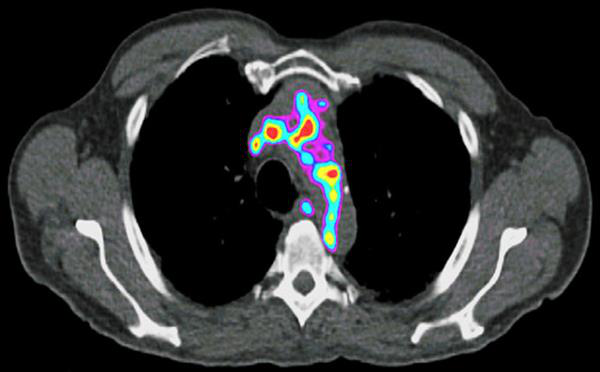 PET scan of a human artery