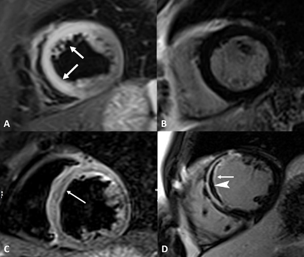 Cardiac MR images acquired from a 44-year-old woman with acute chest pain and chronic cocaine abuse for more than 10 years