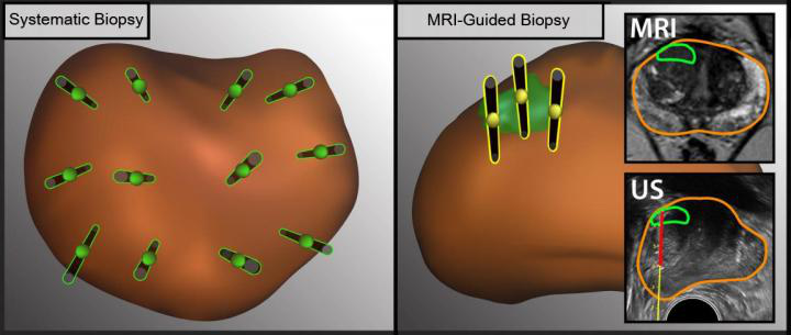 The difference between ultrasound- and MRI-guided methods to obtain tissue samples from different regions in the prostate