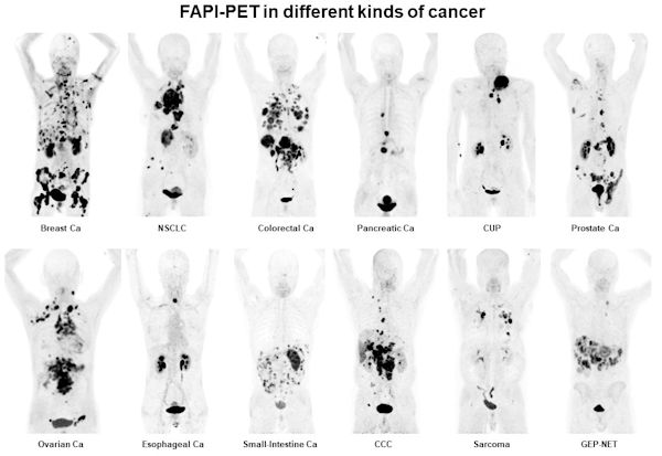 Ga-68 FAPI PET/CT in patients shows 12 different tumor entities