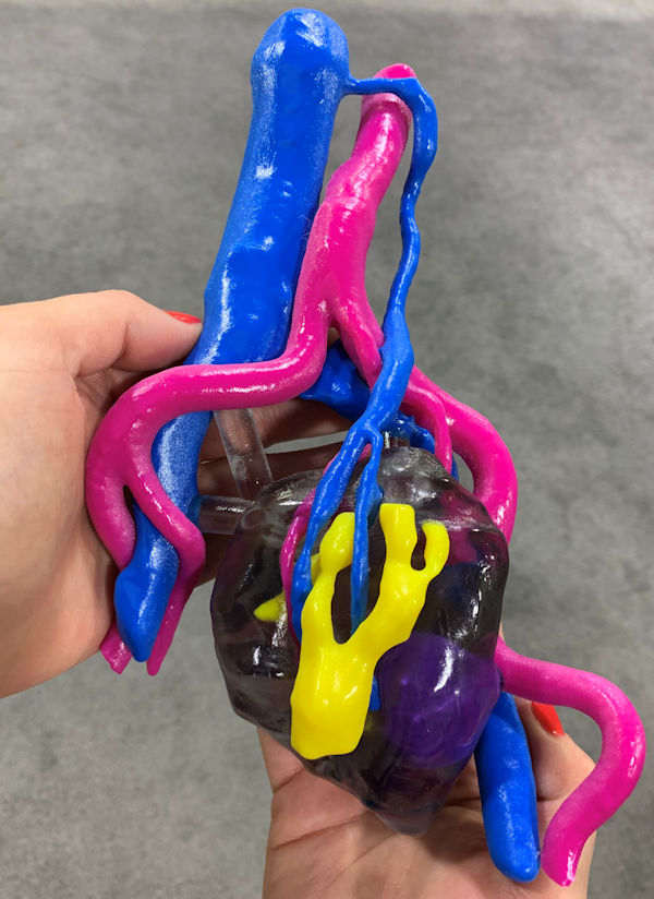3D-printed kidney model 