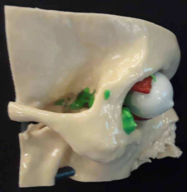 3D-printed craniofacial model 