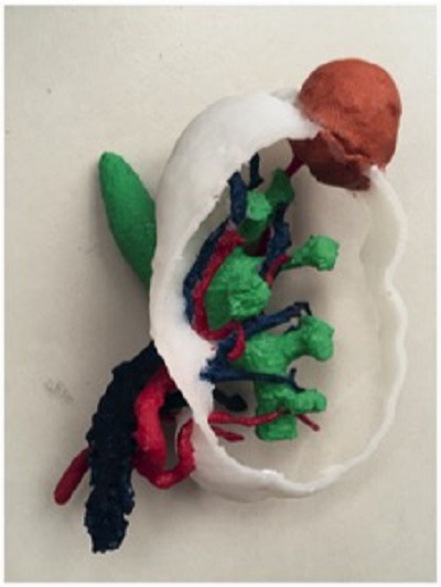 3D-printed kidney based on patient CT scans