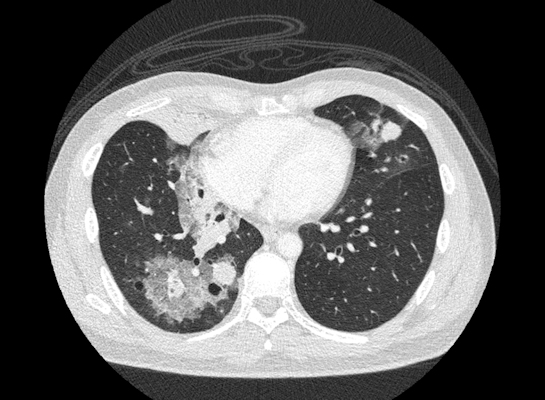 Ultrahigh-resolution CT scan of the chest showing metastatic bladder cancer