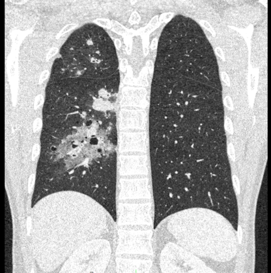 Ultrahigh-resolution CT scan of the chest showing metastatic bladder cancer