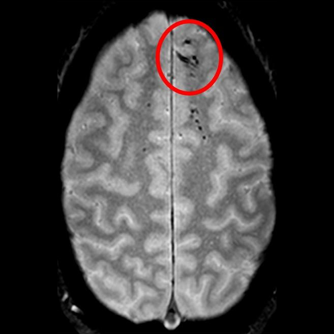 Traumatic microbleeds appear as dark lesions on MRI scans and suggest damage to brain blood vessels after head injury