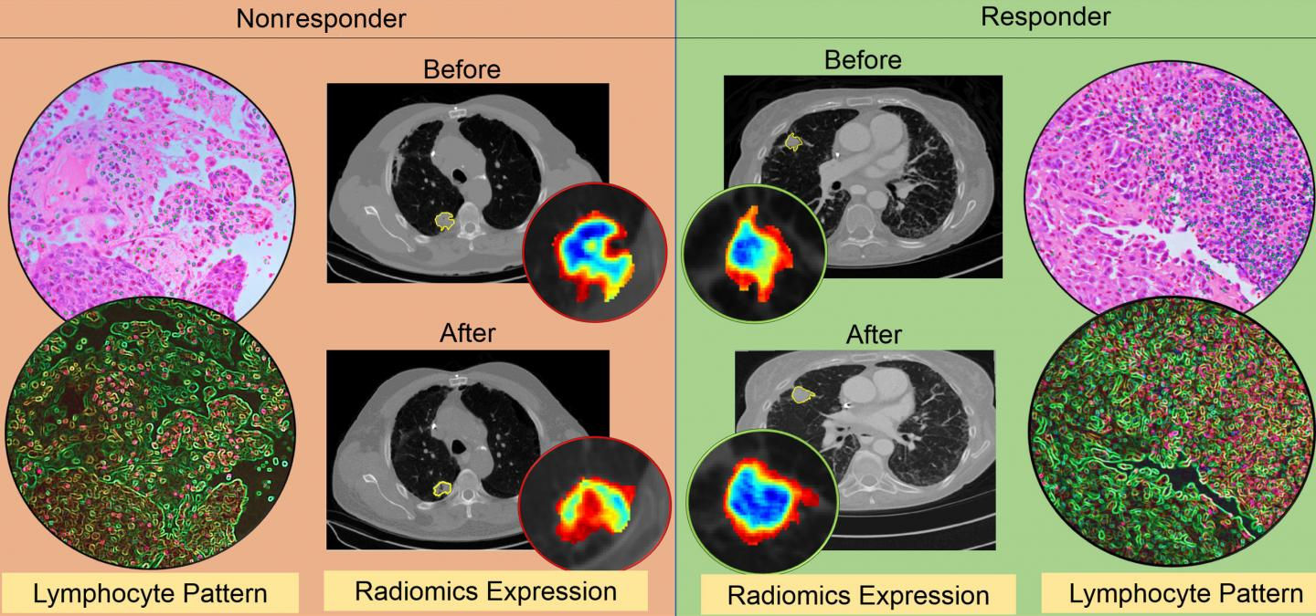 CT radiomic patterns showing higher density of tumor infiltrating lymphocytes on diagnostic biopsies after initiation of checkpoint inhibitor therapy