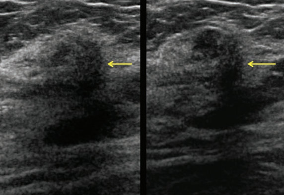 Compound ultrasound images show vague mass in the right breast