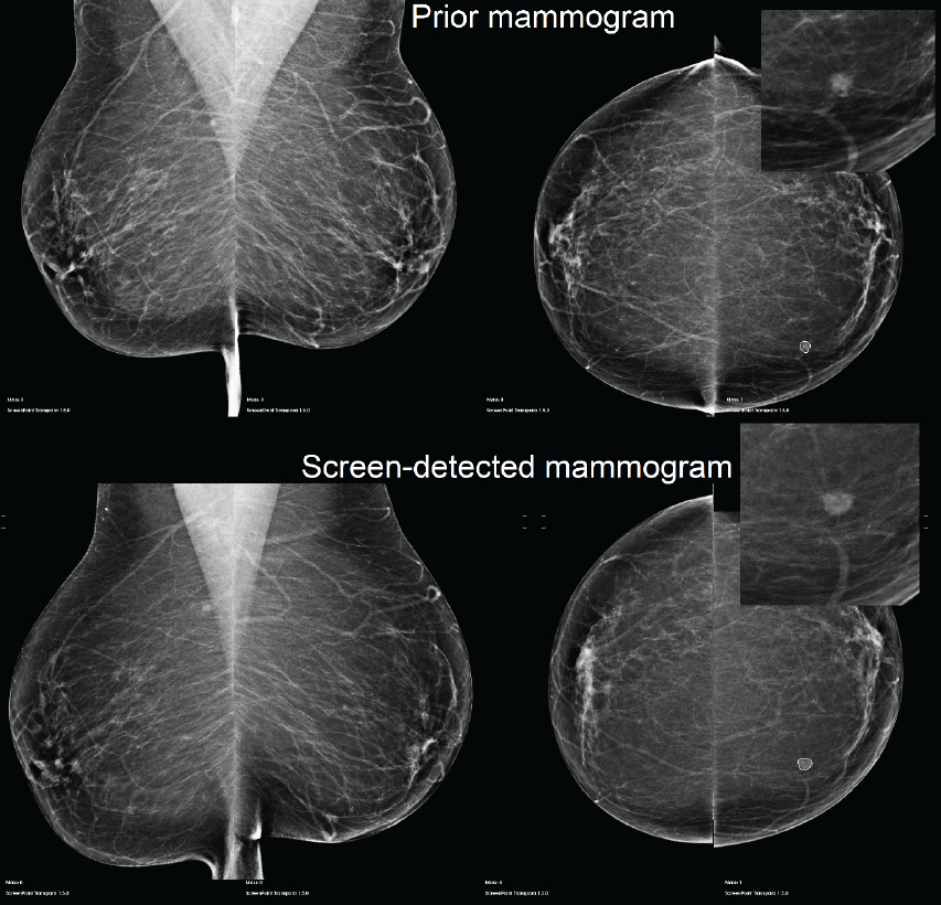 Example of a case of an invasive ductal carcinoma grade 2 screen-detected cancer in the left breast