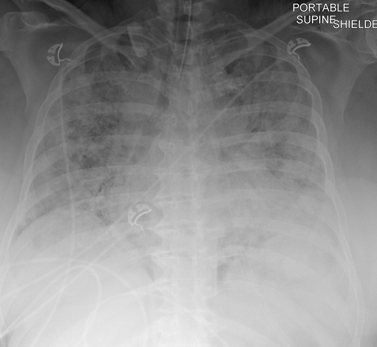 Radiograph of a 51-year-old woman who recently quit smoking and starting vaping nicotine one week prior to examination
