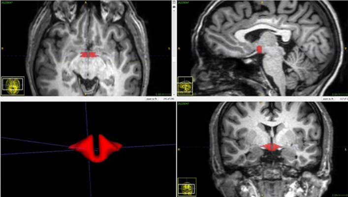 Brain MRI depicts hypothalamus in red