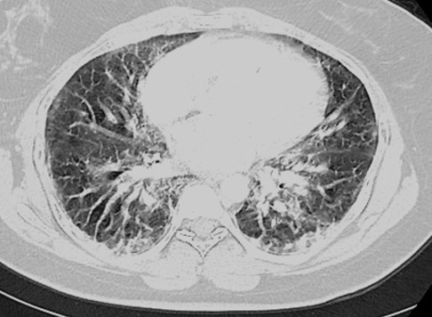 CT chest scan on initial presentation to the emergency department