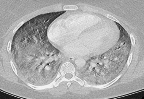 CT chest scan several days later, after developing ARDS