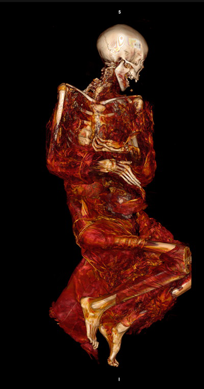 CT scan of an Inuit mummy which led to the detection of vascular calcification