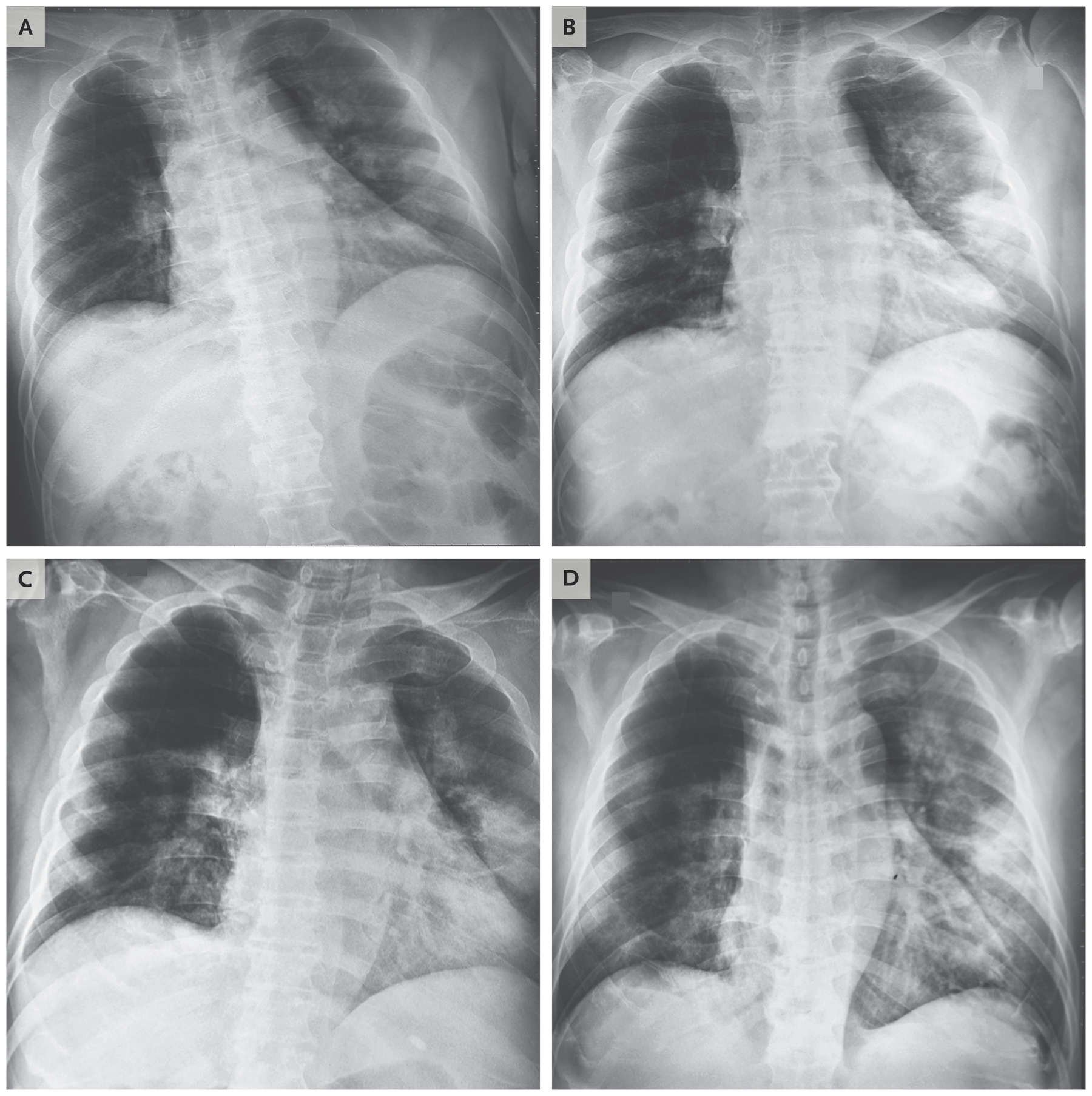Chest radiographs obtained at admission (A) and on day 3 (B) of man who had traveled to Wuhan