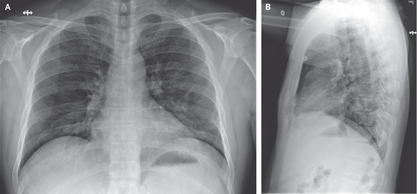Anteroposterior and lateral chest radiographs of a 35-year-old man on the 10th day of illness showing stable streaky opacities in the lung bases, likely indicating atypical pneumonia