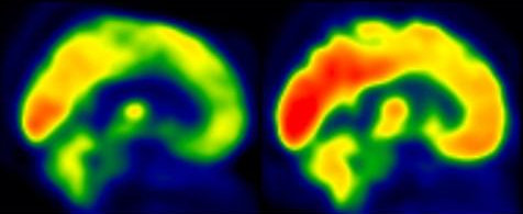 FDG-PET images represent brain glucose metabolism from a subject with low levels of physical activity group and from a participant in the moderate-intensity aerobic training group. The scan from the moderate-intensity training group shows increased brain glucose metabolism
