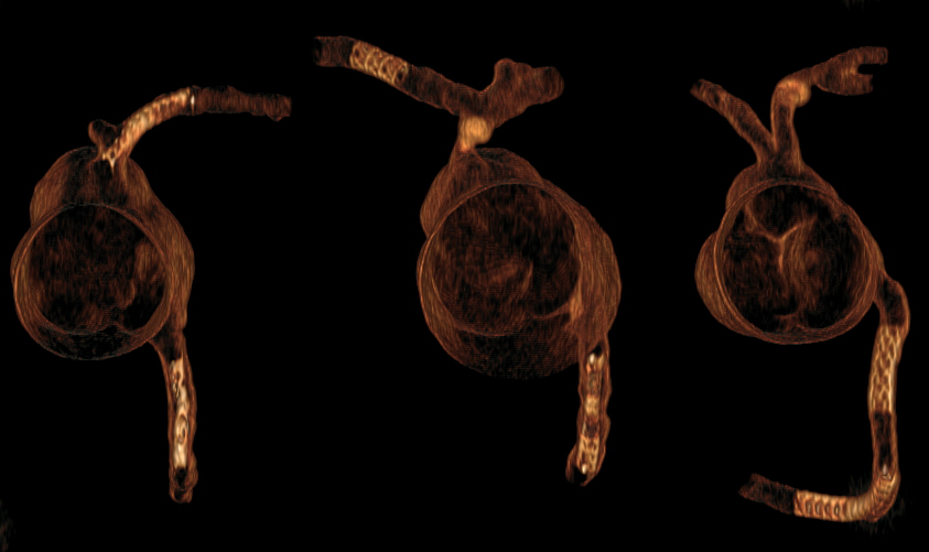 3D CT visualization of personalized 3D-printed coronary models, with coronary stents in the main left and right coronary arteries simulating coronary stenting