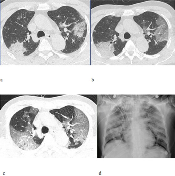T scans of a 71-year-old male with the novel coronavirus showing ground-glass opacities with consolidation and reticular and/or interlobular septal thickening upon admission, two days later, and four days later. A chest x-ray obtained six days after admission shows diffusely increased opacities in both lungs