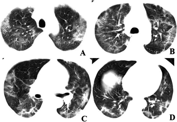hest CT scans of a 60-year-old male with COVID-19 showing multifocal ground-glass opacities and mixed consolidation in the peripheral area of both lungs. DNA tests returned negative for 2019-nCoV until the eight day after presentation