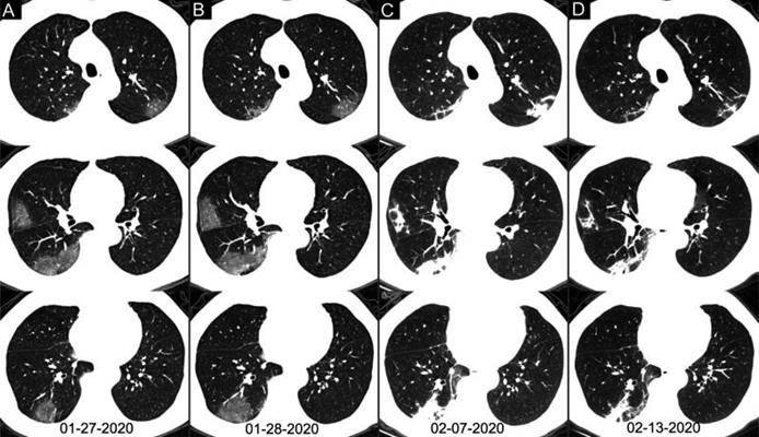 Axial chest CT images of a 62-year-old man with COVID-19 showing disease progression over time, from bilateral ground-glass opacities on January 27 to multifocal organizing consolidation on February 13. He had multiple negative results from RT-PCR tests, including those obtained on February 3 and 11