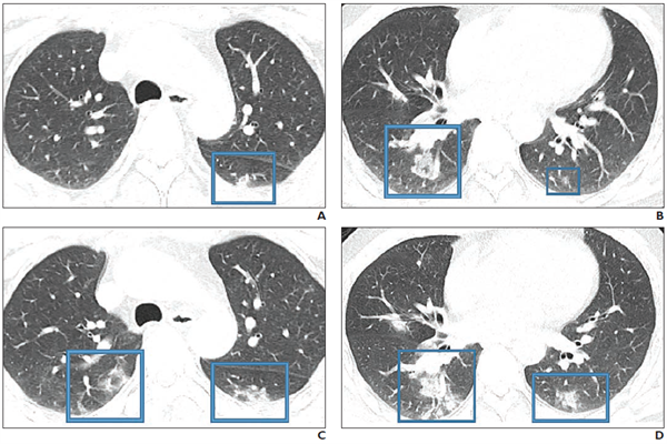 CT lung scan images of a 47-year-old Chinese man with two-day history of fever, chills, productive cough, sneezing, and fatigue who presented to emergency department and was subsequently diagnosed with COVID-19