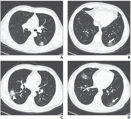 A 37-year-old man with confirmed COVID-19, common type. Patient had short-term exposure history to Wuhan and onset symptoms of fever (38° C) and cough. CT was performed on day of admission. CT images show bilateral multifocal ground-glass opacities and mixed ground-glass opacities and consolidation lesions. Traction bronchiectasis and vascular enlargement also are present.