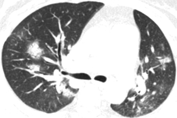CT image of a 58-year-old woman with adenovirus infection showing ill-defined patchy ground-glass opacities and segmental and subpleural consolidations in both lungs, with most lesions along bronchovascular bundles