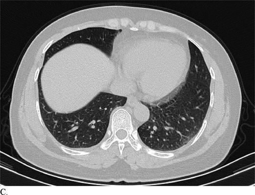 CT image of a patient with COVID-19 misdiagnosed with non-COVID-19 pneumonia