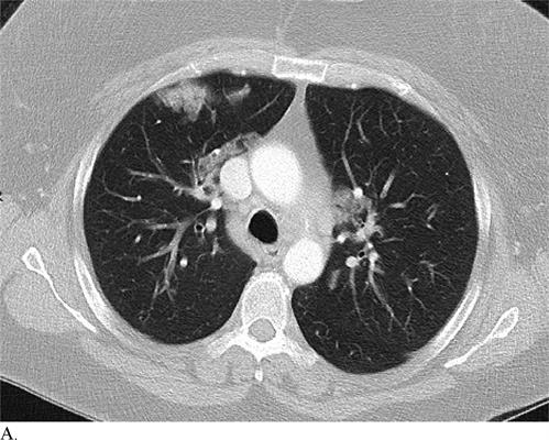 CT image of a patient with pneumonia misdiagnosed with COVID-19