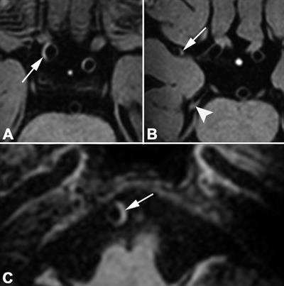 MR images of a 69-year-old man with left-sided ischemic stroke 56 days after symptom onset. His cardiovascular risk factors were hypertension and diabetes mellitus. The Second Manifestations of Arterial Disease vascular risk score was 37%, indicating a 37% chance of a recurrent vascular event within 10 years. Fourteen vessel wall lesions were detected on pre- and postcontrast 7-tesla transverse 3D T1-weighted MRI. In the anterior circulation, postcontrast images show vessel wall thickening of the supraclinoid portion of the right internal carotid artery and right M1 segment. In the posterior circulation, postcontrast images show vessel wall lesions in right P2 segment and basilar artery