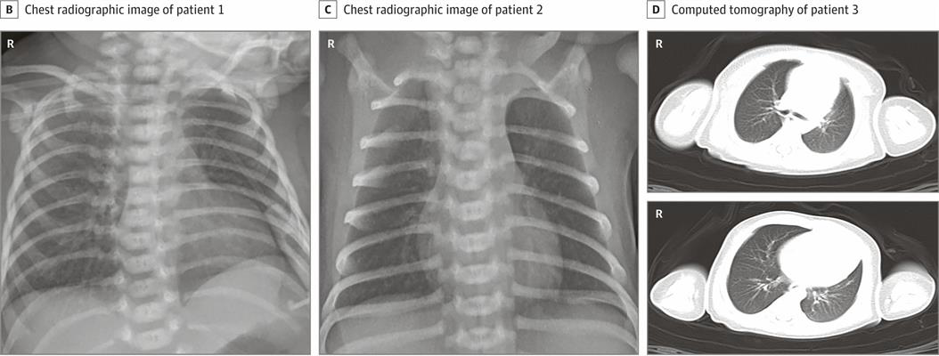 Images of newborns with COVID-19 showing pneumonia on chest x-ray and CT