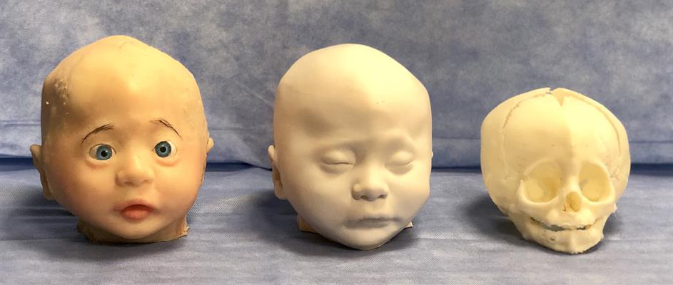 	<div class="caption">
3D-printed models based on head CT scans of a patient with metopic craniosynostosis