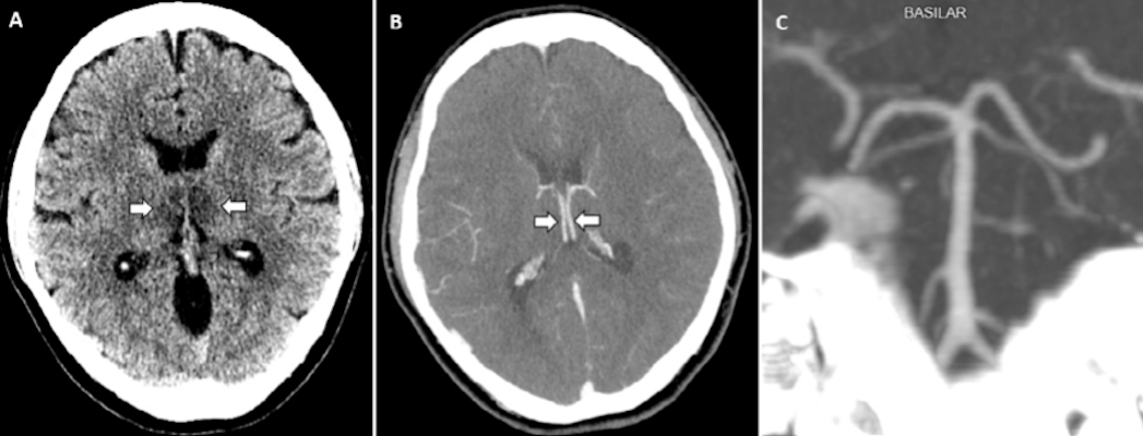An image from noncontrast head CT demonstrates symmetric hypoattenuation within the bilateral medial thalami. An axial CT venogram demonstrates patency of the cerebral venous vasculature, including the internal cerebral veins. A coronal reformat of a CT angiogram demonstrates normal appearance of the basilar artery and proximal posterior cerebral arteries