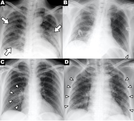 A series of chest x-ray findings of a patient with COVID-19 demonstrating clinical characteristics of disease: patchy consolidations, pleural effusion, perihilar distribution, and peripheral distribution