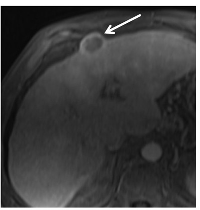 MR image is from a 60-year-old woman with 2.7-cm macrotrabecular-massive hepatocellular carcinoma. Transverse multiphase MRI scans show the macrotrabecular-massive hepatocellular carcinoma as a hyperintense central area on T2-weighted image, corresponding to substantial necrosis