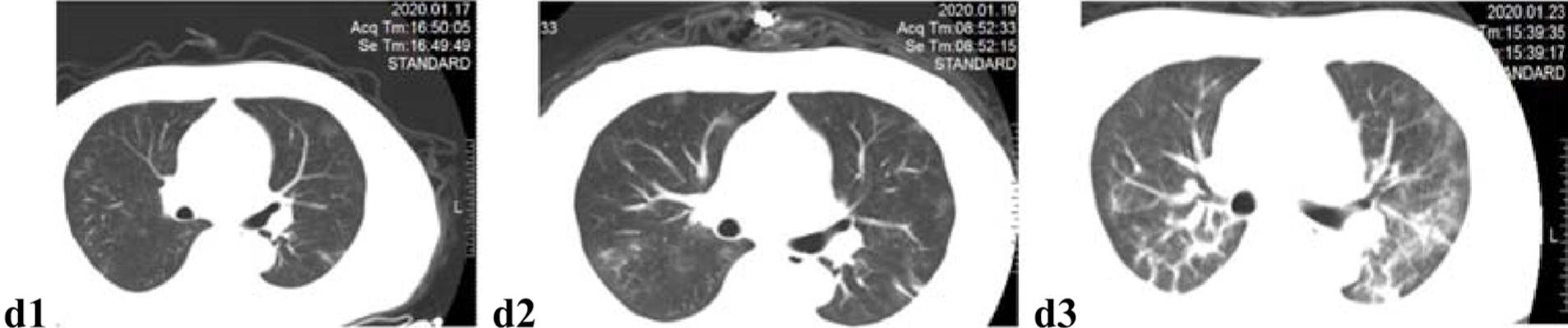 Unehanced axial CT images of a 52-year-old male doctor with asthma show the progression of novel coronavirus pneumonia
